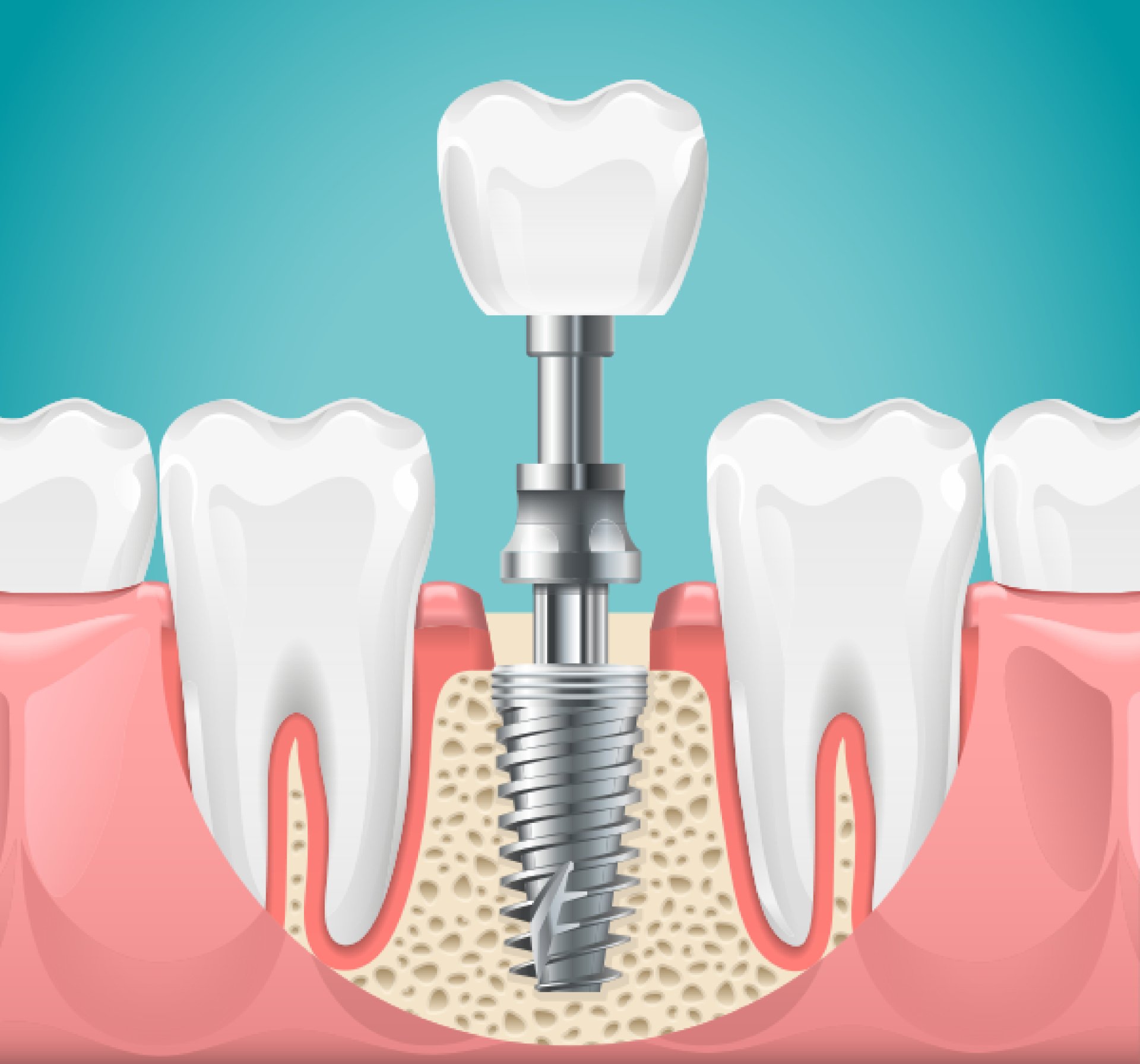 dental+implants dental+implants